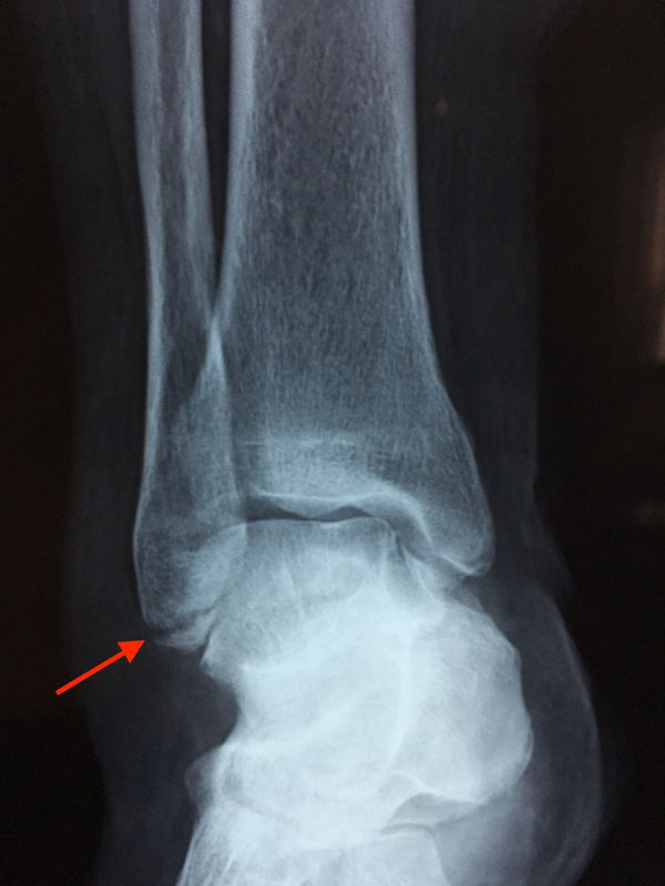 katagma_ekso_sfyrou_pro